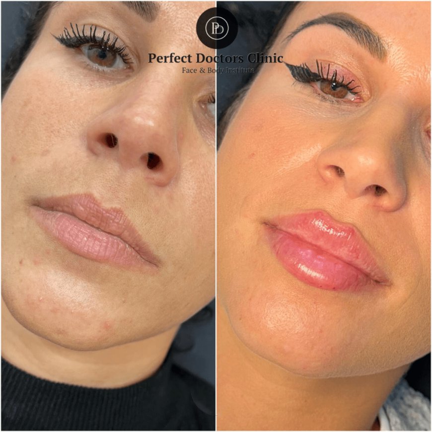 Juvederm for Nasolabial Folds at the Best Aesthetic Clinics in Dubai