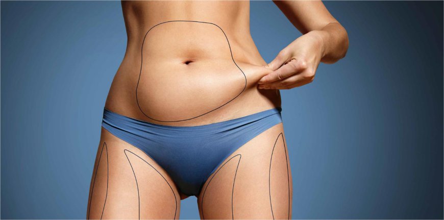 Who Is an Ideal Candidate for Abdominoplasty Dubai?