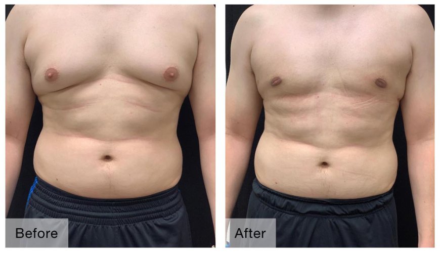 Gynecomastia Surgery: What Every Patient Should Know