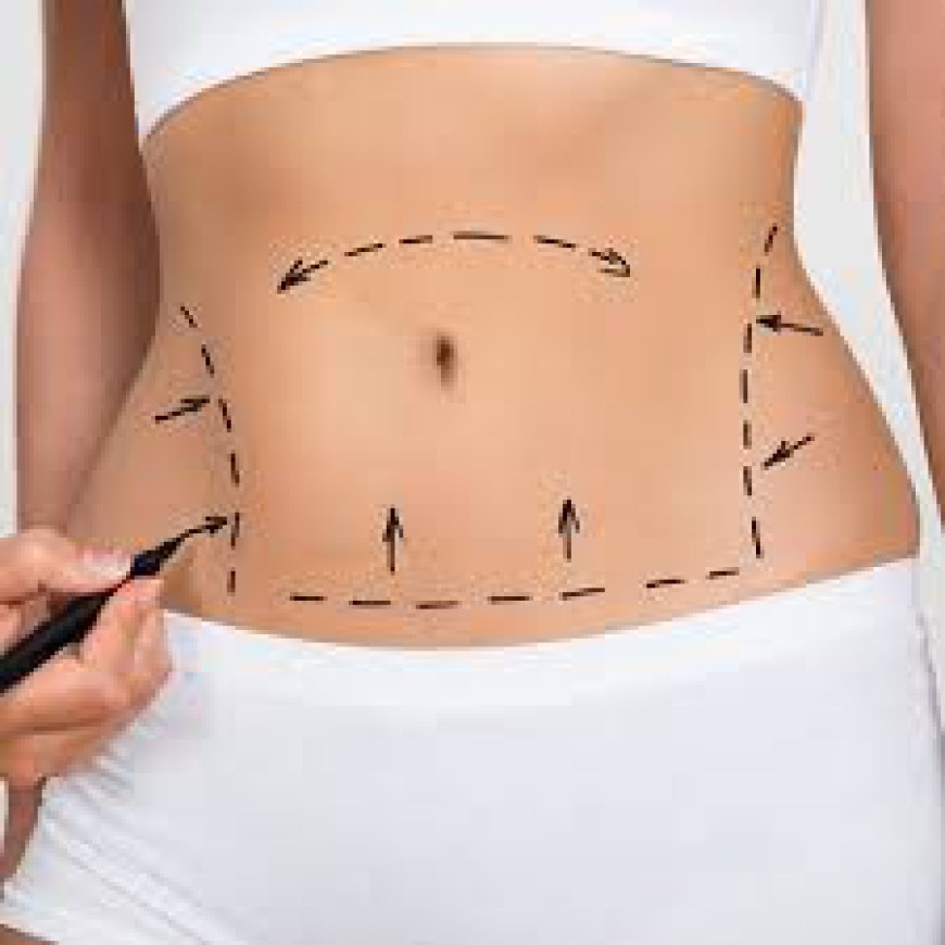 Can Liposuction Remove Stubborn Fat Deposits?