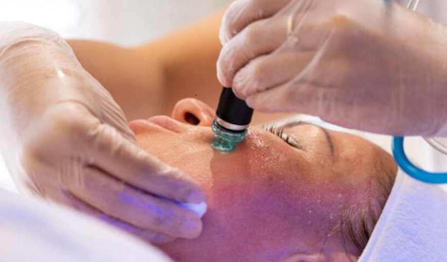 Does Radio Frequency Treatment Help Reduce Acne Scars Effectively?