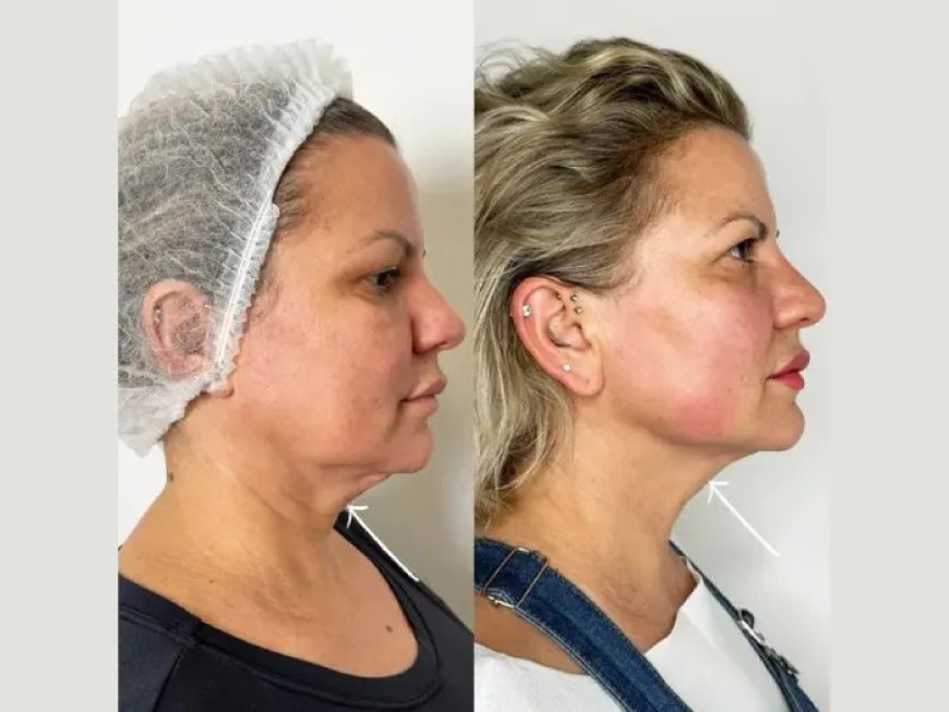 Endolift Treatments in Dubai for advanced non surgical skin tightening