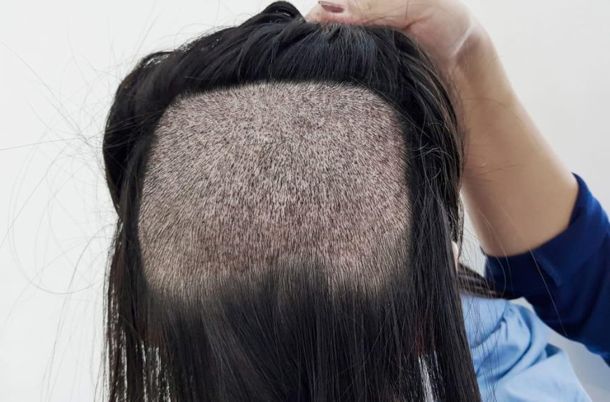 What Is FUE Hair Transplant and How Does It Work?