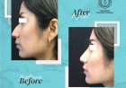 Who Is the Best Expert for Nose Surgery in Islamabad Today?