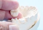 The Pros and Cons of Dental Crowns