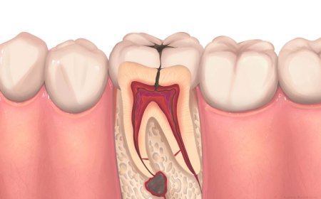 Signs You Might Need Root Canal Treatment