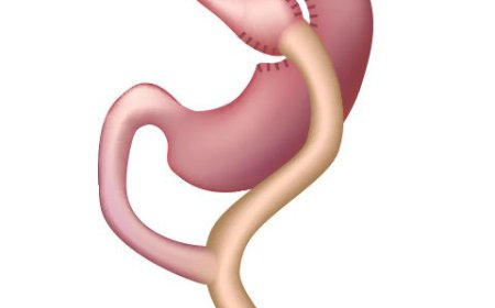 How Does Gastric Bypass Work?