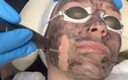 Is Spectra Carbon Peel Safe for All Skin Types?