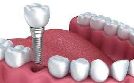 Who Is an Ideal Candidate for Dental Implants?