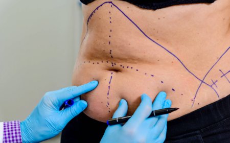 Is Laser Liposuction Safe? Everything You Need to Know