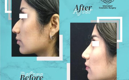 Who Is the Best Expert for Nose Surgery in Islamabad Today?