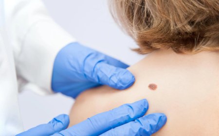 Can Birthmarks Be Safely Removed?