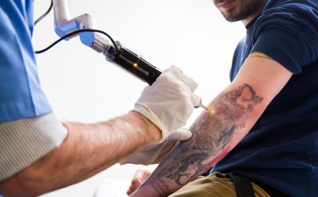 How Does PicoSure Remove Tattoos Effectively?