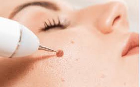 The Sensory Experience of Mole Removal in Dubai
