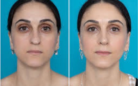 UAE Full Face Fat Transfer: What It Actually Feels Like When You Stop Chasing Fillers