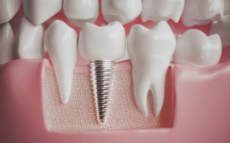 After Care For Dental Implants What No One Explains Properly