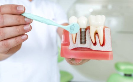 Dental Implants Caldwell Patients Trust For Lasting Confident Smiles