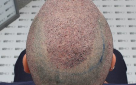 How Does a Crown Hair Transplant Work?