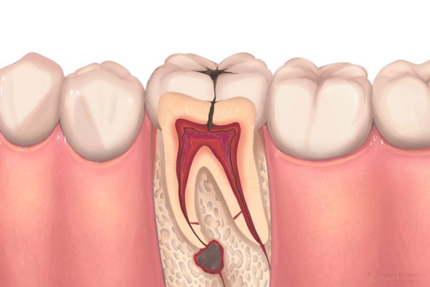Signs You Might Need Root Canal Treatment