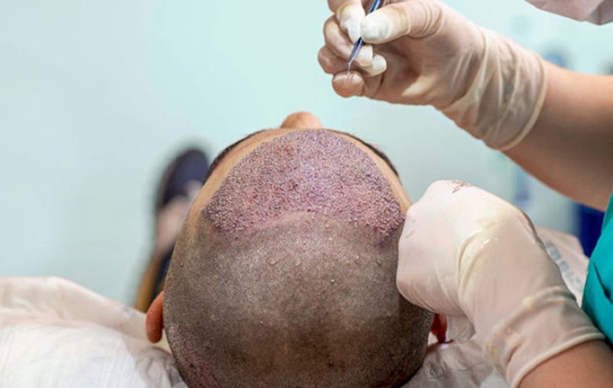How Does a Hair Transplant Work?