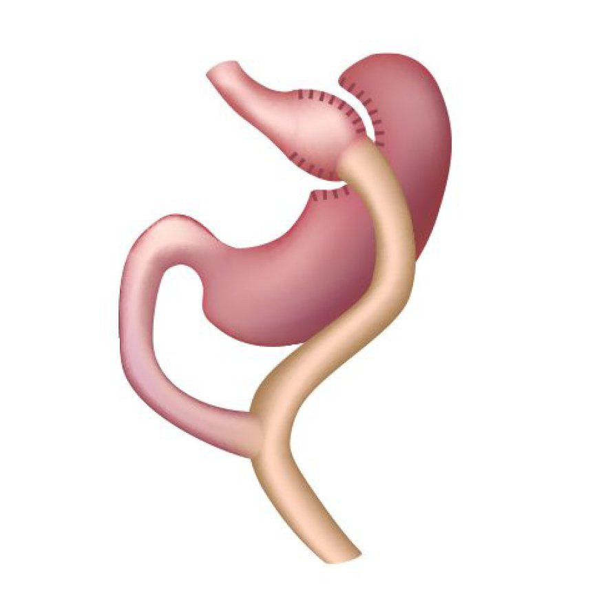 How Does Gastric Bypass Work?