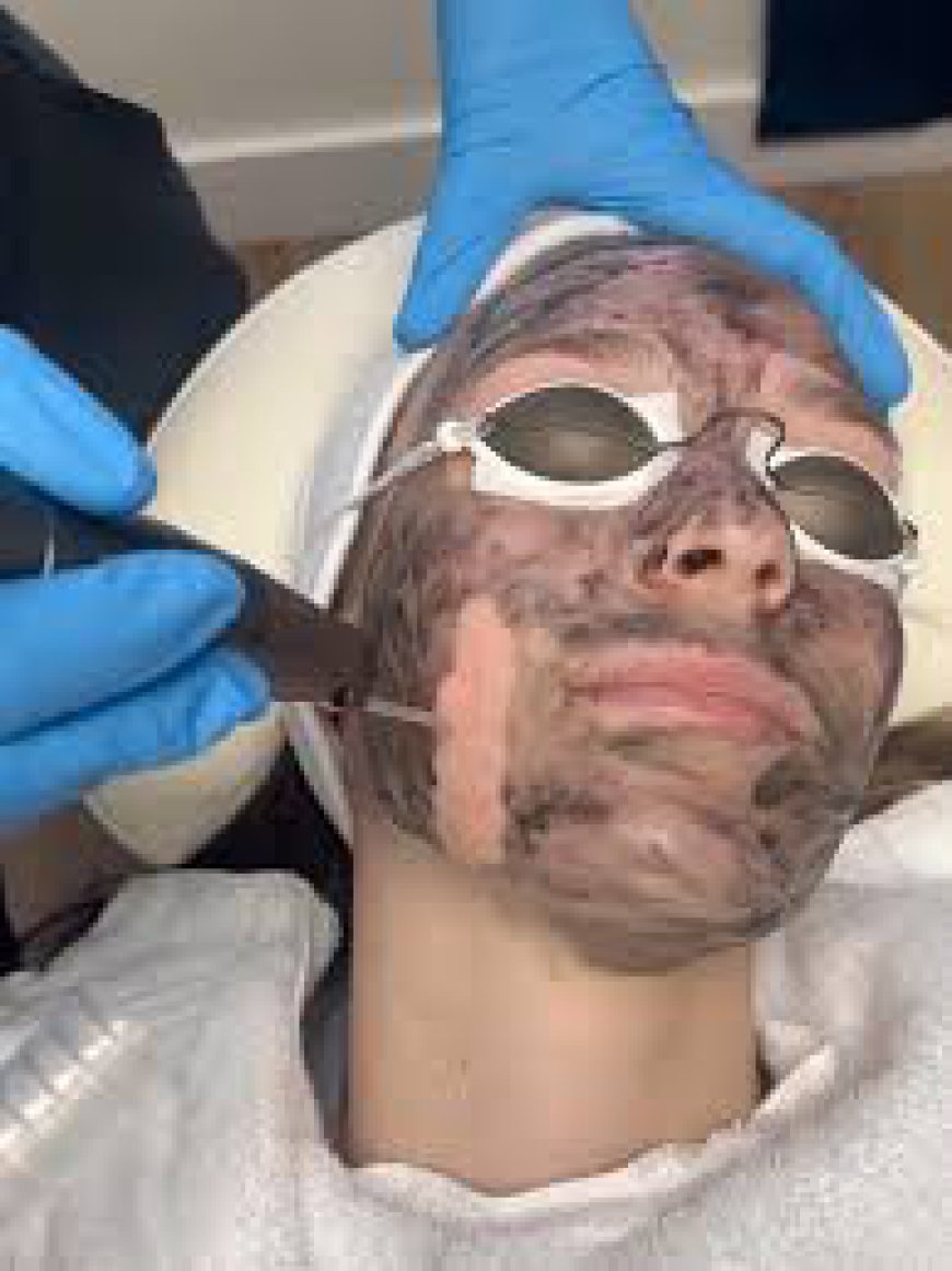Is Spectra Carbon Peel Safe for All Skin Types?