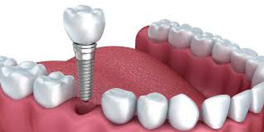 Who Is an Ideal Candidate for Dental Implants?