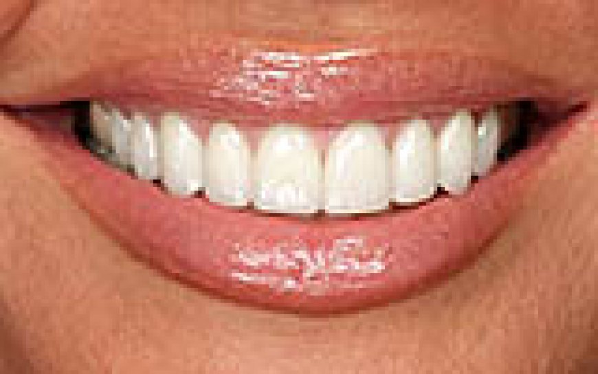 Teeth Whitening in Lewisville: Everything You Need to Know Before Booking
