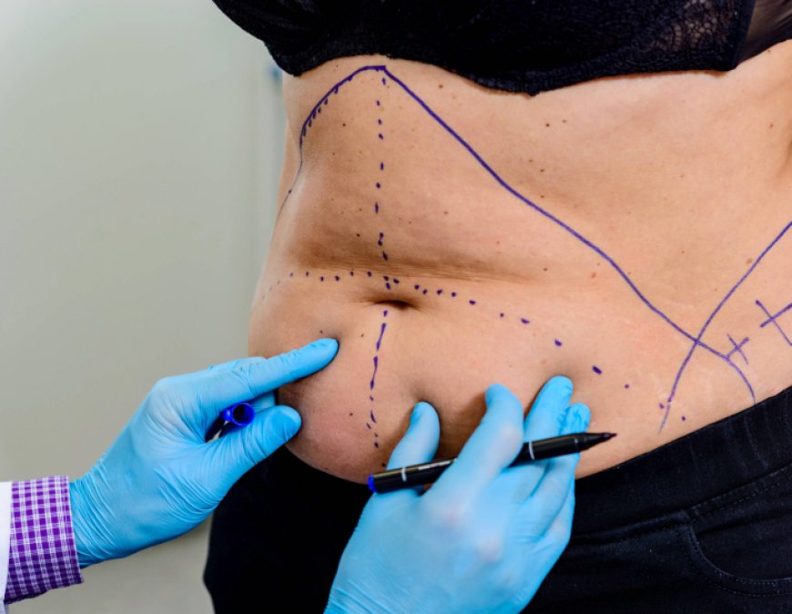 Is Laser Liposuction Safe? Everything You Need to Know