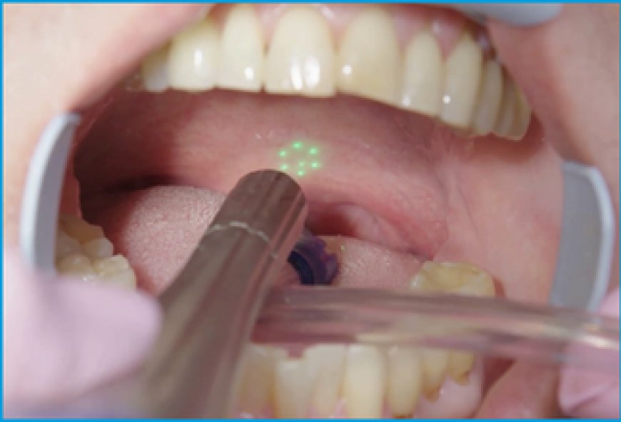 What Is Laser Snoring Treatment?