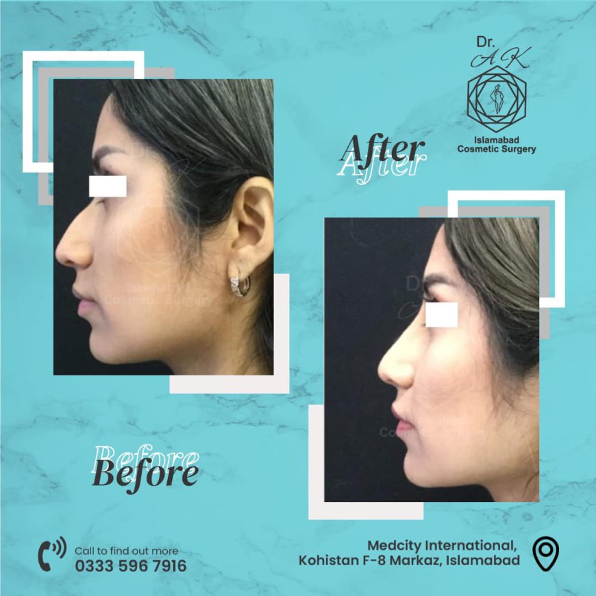 Who Is the Best Expert for Nose Surgery in Islamabad Today?