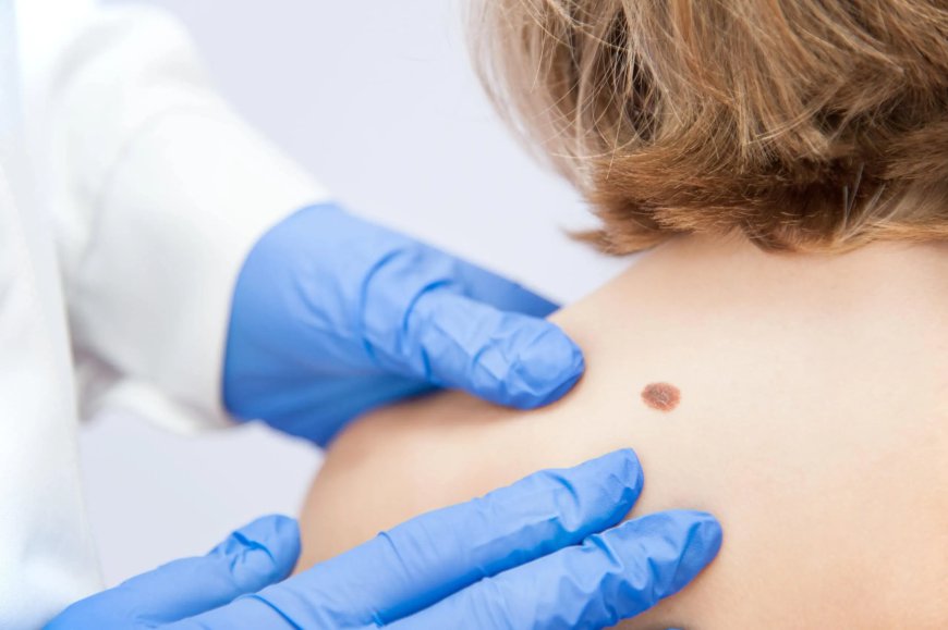 Can Birthmarks Be Safely Removed?