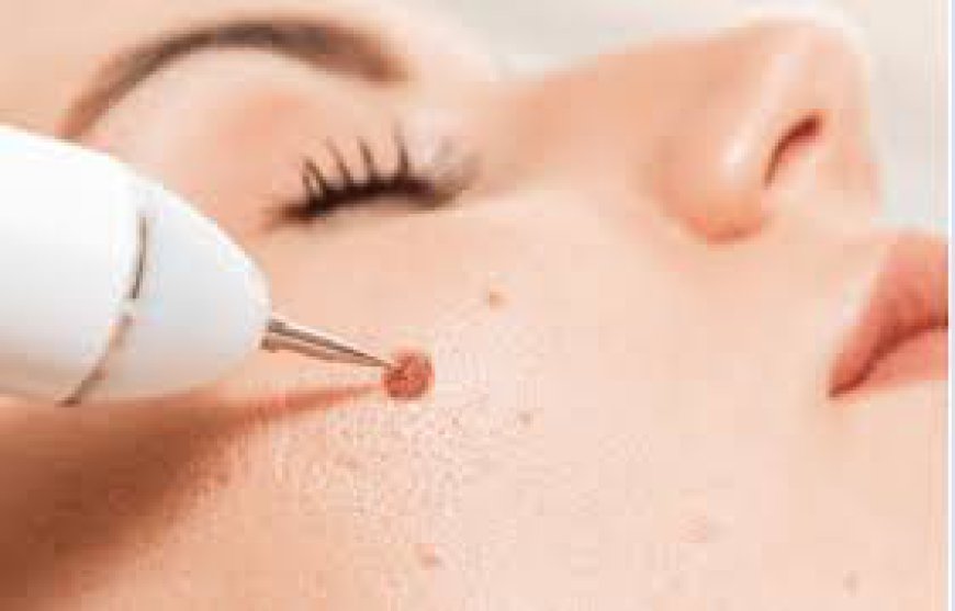 The Sensory Experience of Mole Removal in Dubai