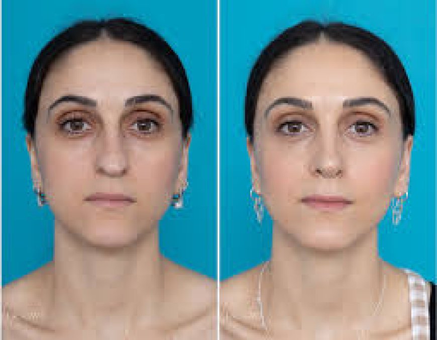 UAE Full Face Fat Transfer: What It Actually Feels Like When You Stop Chasing Fillers