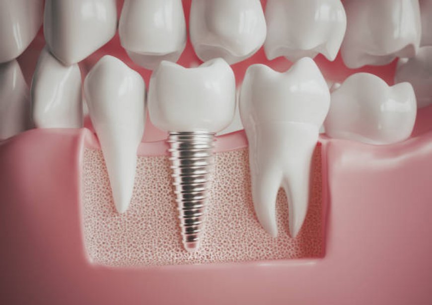 After Care For Dental Implants What No One Explains Properly