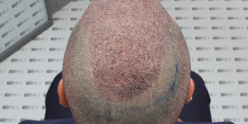How Does a Crown Hair Transplant Work?