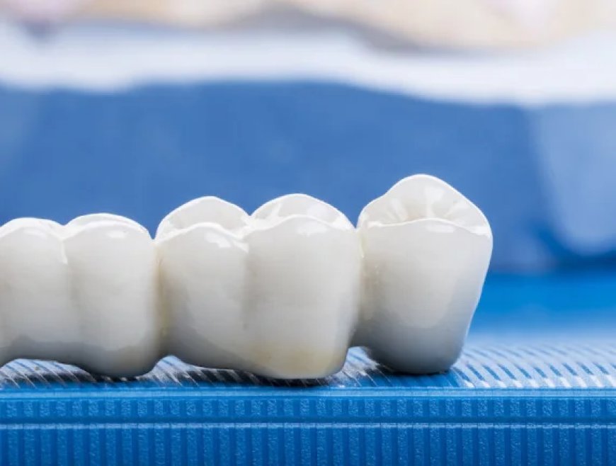 Dental Bridge Services in Bloomingdale - Eagle Falls
