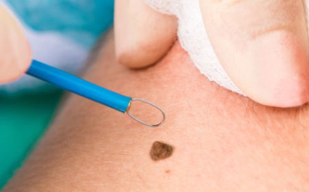 What Is Mole Removal and How Is the Procedure Performed?