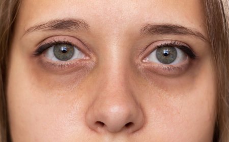 How Can Dark Circles Be Treated Effectively?
