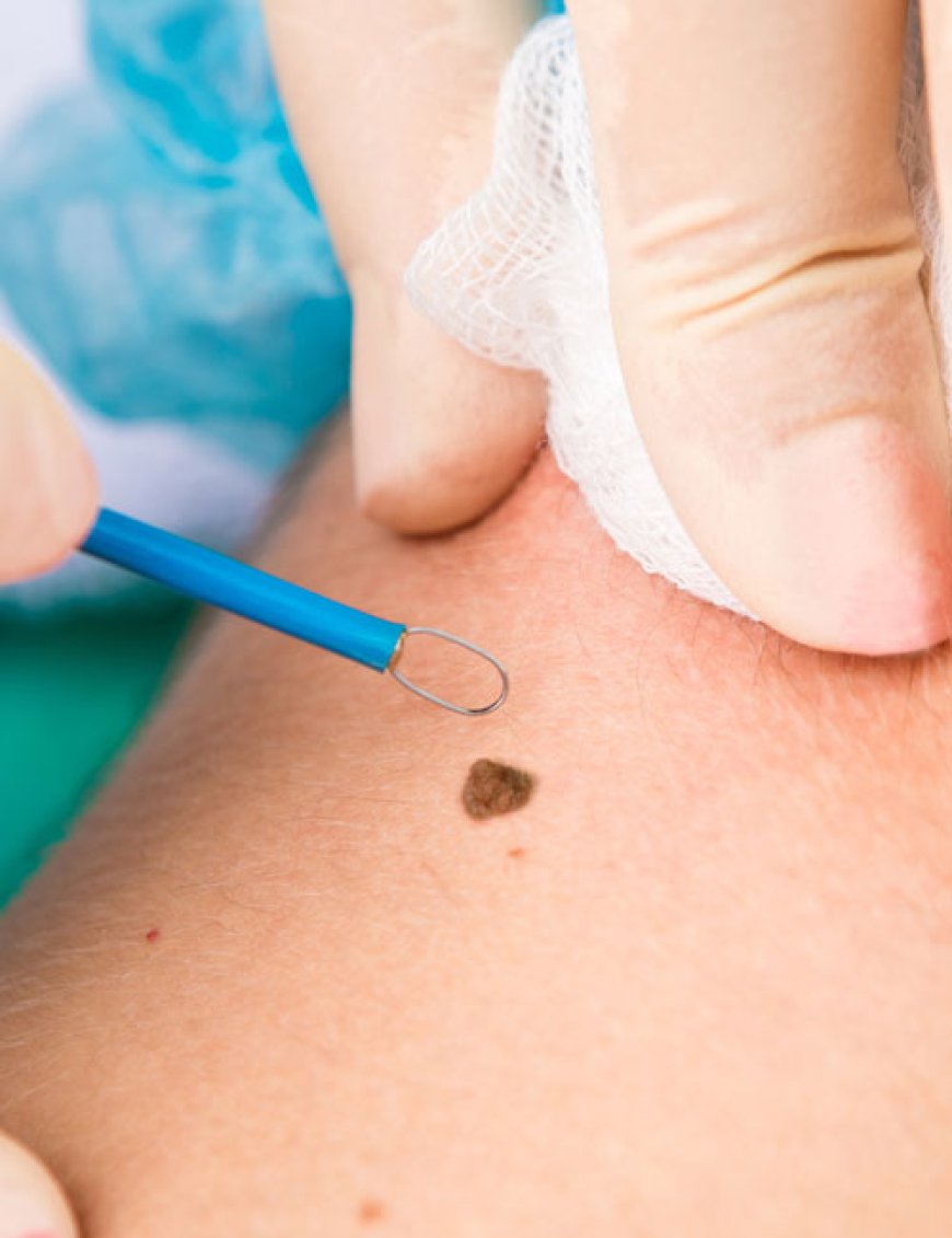 What Is Mole Removal and How Is the Procedure Performed?