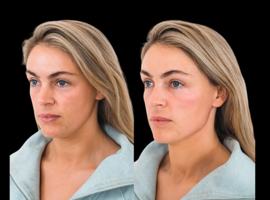 Top 5 Reasons to Try Cheek Fillers Treatment in Dubai