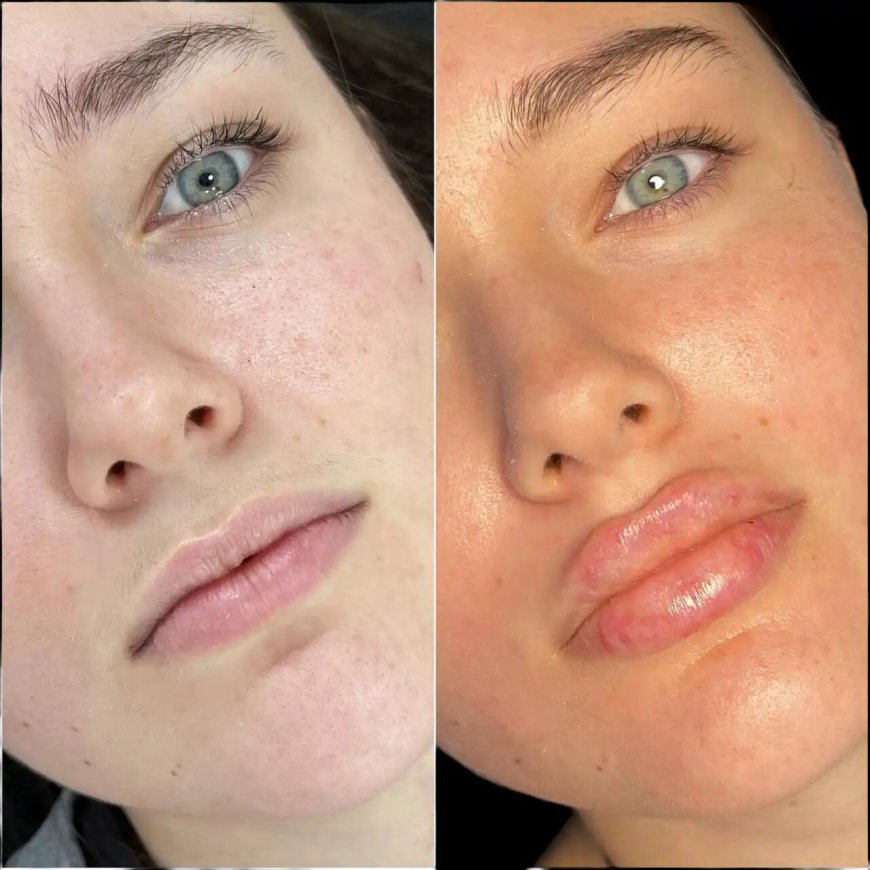 Personalized Fillers Treatment in Dubai for Every Body Type