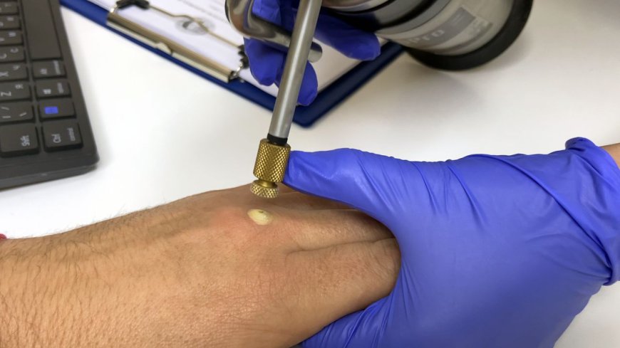 What Conditions Can Cryosurgery Treat?