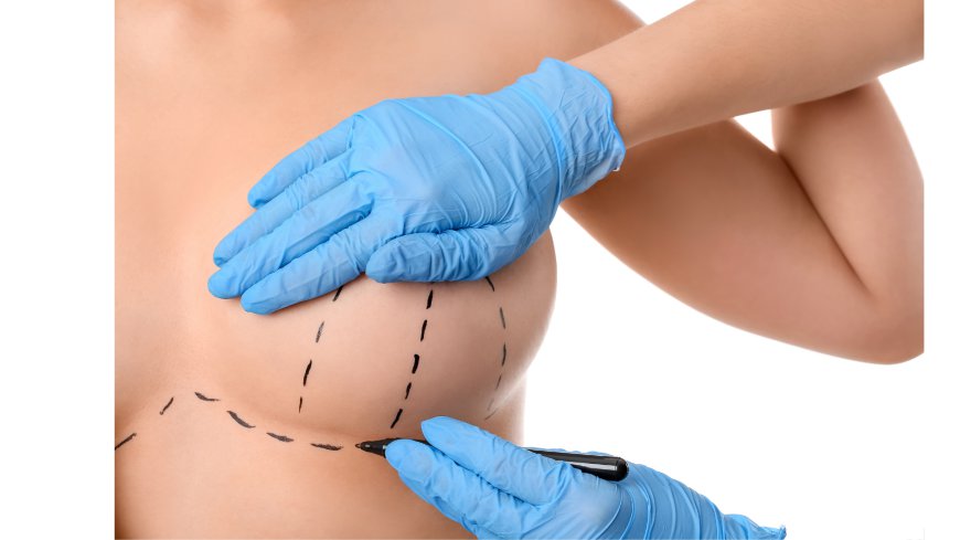 What Is a Breast Lift Procedure and How Is It Performed?
