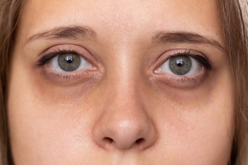 How Can Dark Circles Be Treated Effectively?