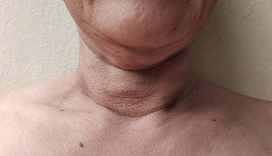 Why More People Are Talking About Desiccated Thyroid Treatment with Dr Uribe