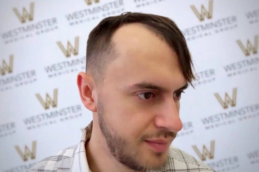 Hair Transplant London: Common Myths and Misconceptions Explained