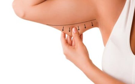 Who Is an Ideal Candidate for Arm Lift Surgery?
