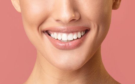 What Are Composite Veneers and How Do They Work?