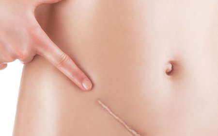 How Does Surgical Scar Revision Work?